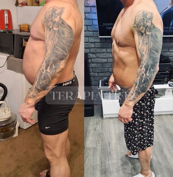 Terapia zastępcza testosteronem