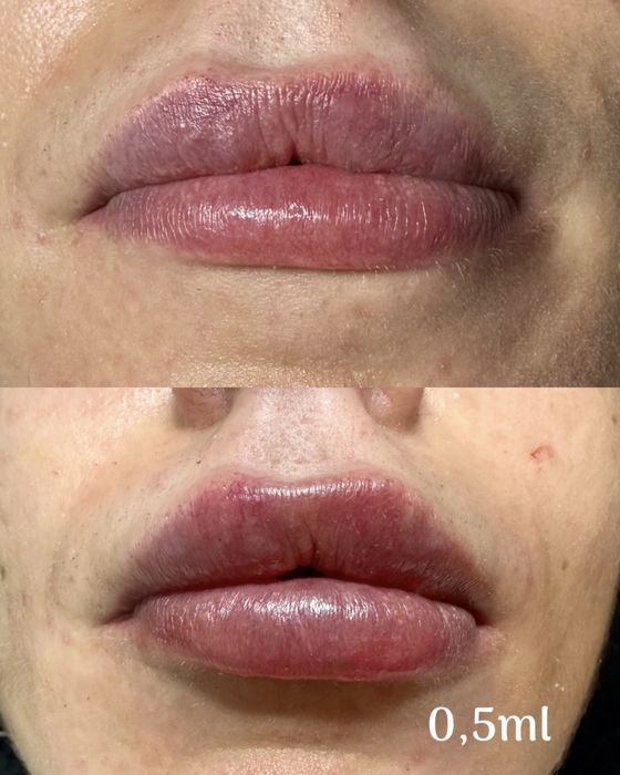 Usta na płasko, BTX, mezoterapia, lipoliza