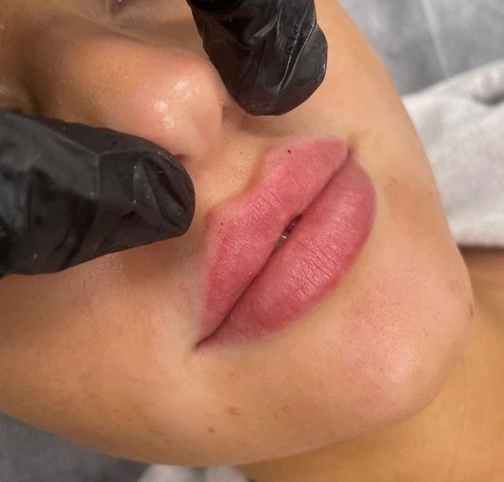 АКЦИЯ!!! Увеличение губ 1700 грн. Колличество мест ограничено!