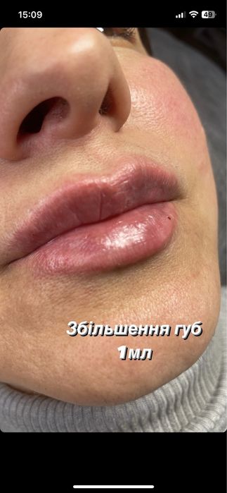 Збільшення губ троєщина 2000-1мл