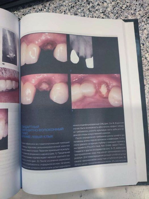 Внутрикорневые реставрации. Дуглас Терри. Стоматология. 2021