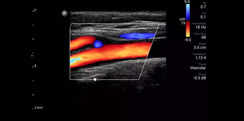 УЗД портативний Philips lumify L12-4