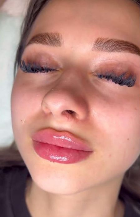 Увеличение губ ,индивидуальный подход. Сертифицированные препараты