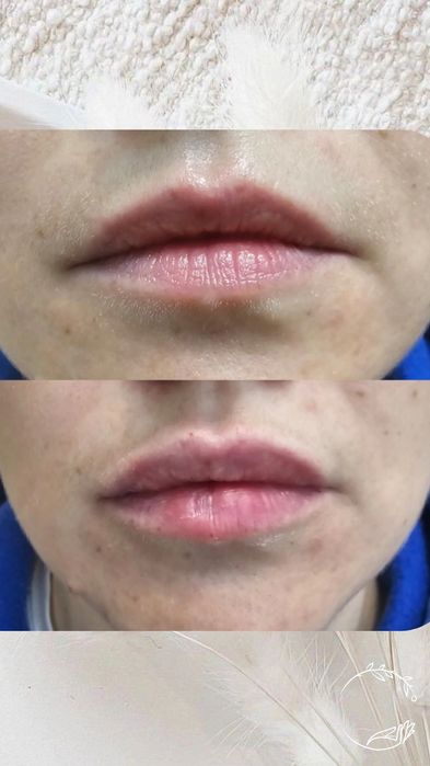 Косметолог. Ботокс, губи, векторний ліфтінг.