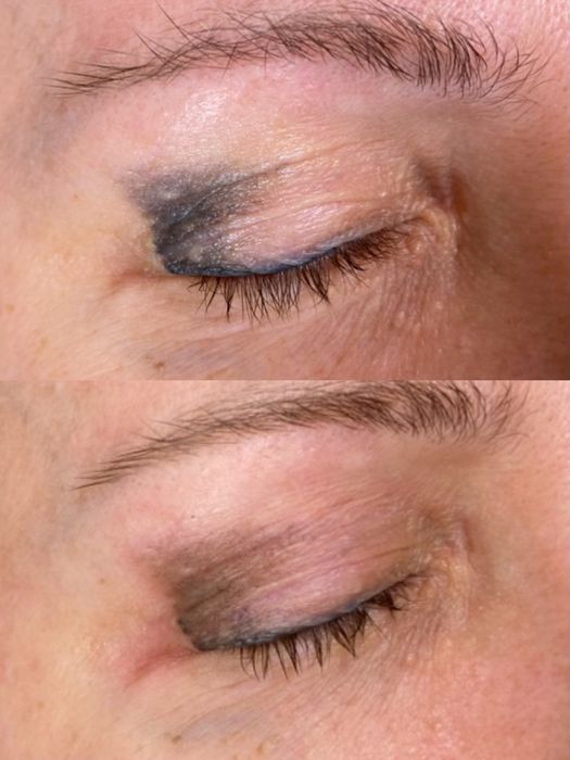 Видалення татуажа тату перманента лазером бровей стрелок губ ремувер