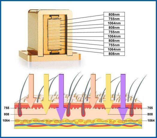 Aluguer LASER DIODO 3 comprimentos de onda (755nm/808nm/1064nm)