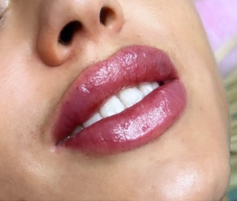 Kwas hialuronowy, botox