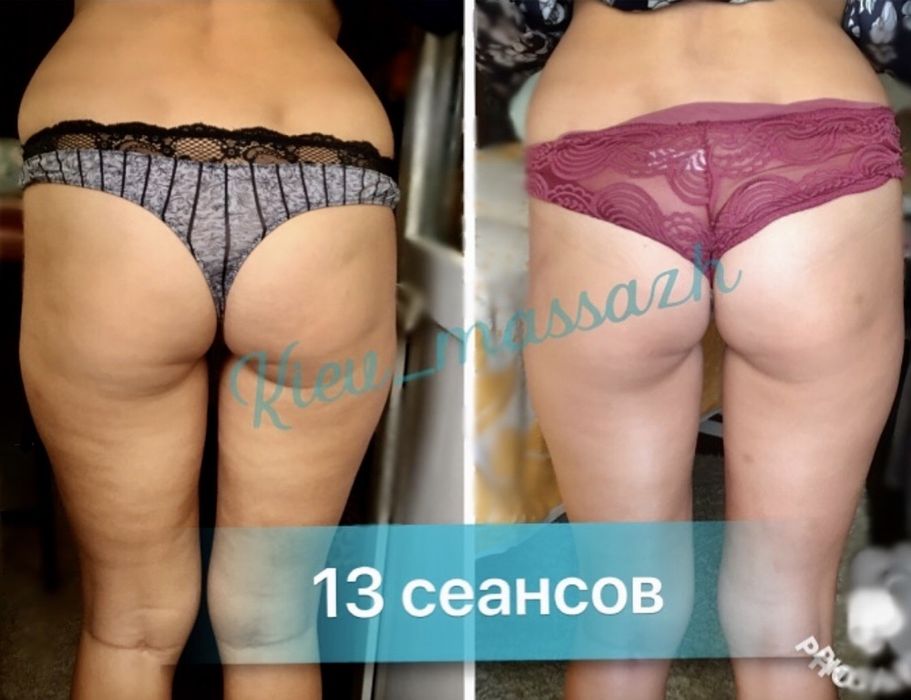 Антицеллюлитный массаж ЖК София