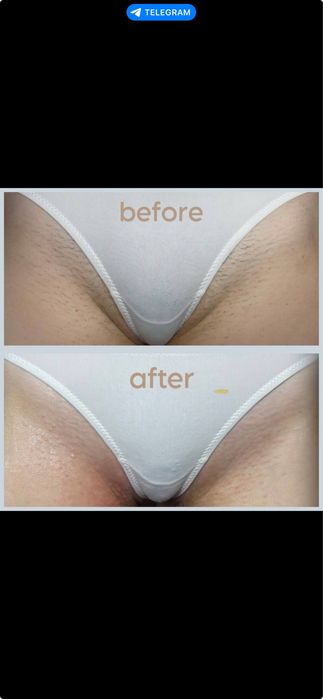 Электроэпиляция, поселок Котовского