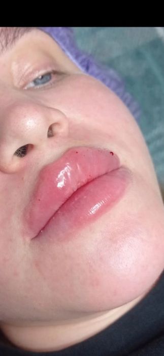 Ботокс, Контурная пластика Услуги косметолога.