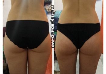 Массаж Антицеллюлитный, Классический, Лимфодренажный