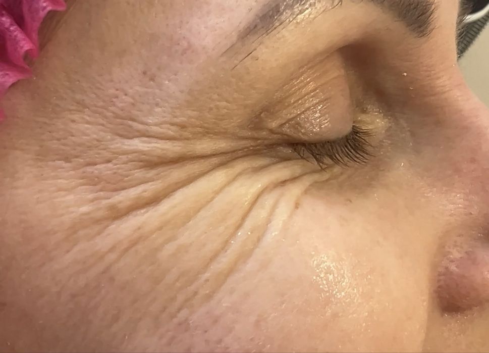 Збільшення губ 1500/3000 | лікар косметолог | моделі