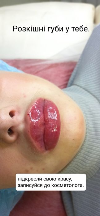 1500 грн губи контурна пластика.Ботокс.