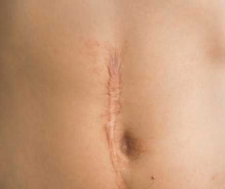 Modelo de micropigmentação e microagulhamento