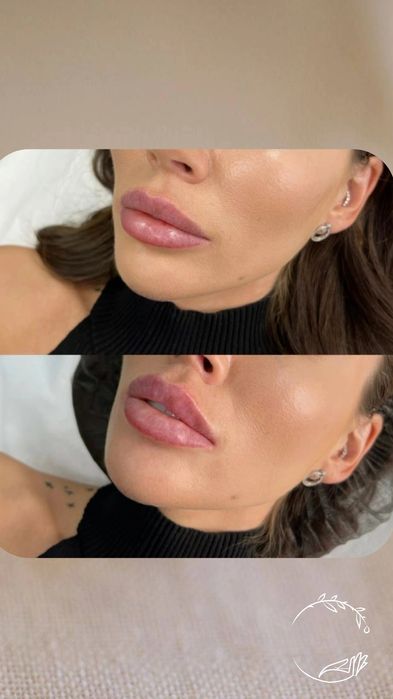 Косметолог (ботокс, контурная пластика губ,мезо, біоревіталізація)