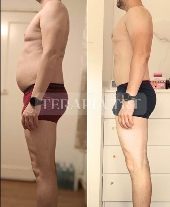 Terapia zastępcza testosteronem