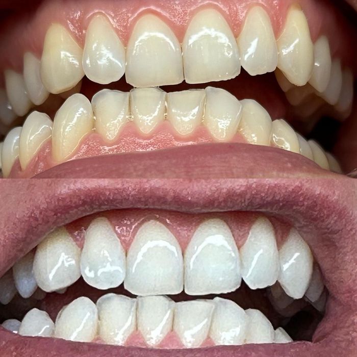 Kosmetyczne wybielanie zębów