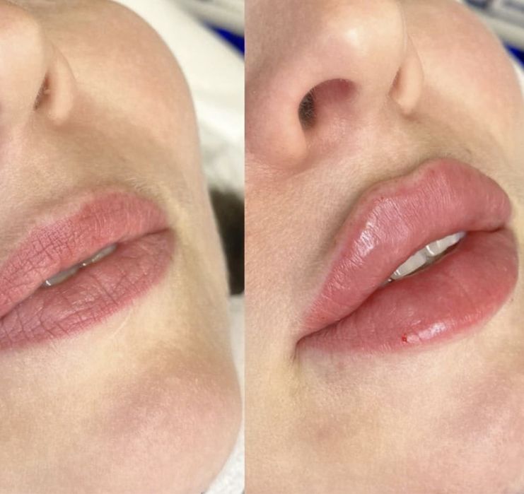 Powiekszanie ust PROMOCJA !!! Botox 200 zl