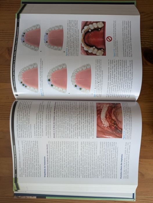 Livro Implantes Dentais Contemporâneos - Carl E. Misch - 3°edição