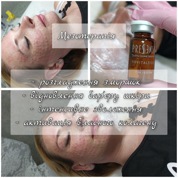 Косметолог. Контурна пластика губ, мезотерапія, біоре-ція, ліполітик.