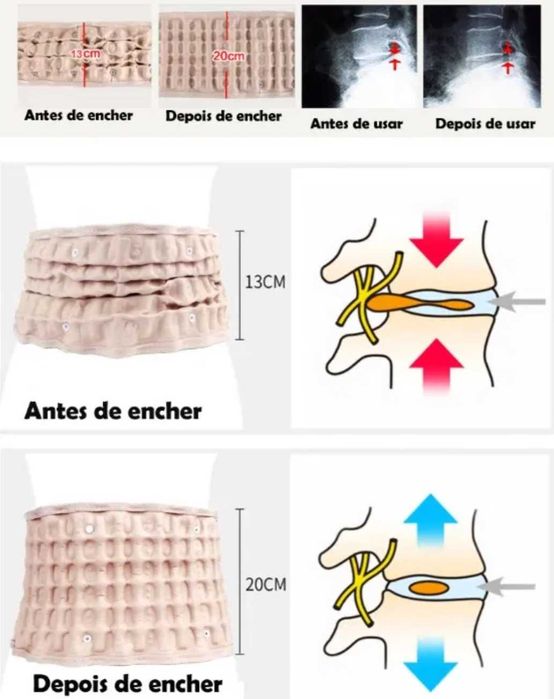 cinta insuflavel para coluna vertebral medula espinhal ciatica hernias