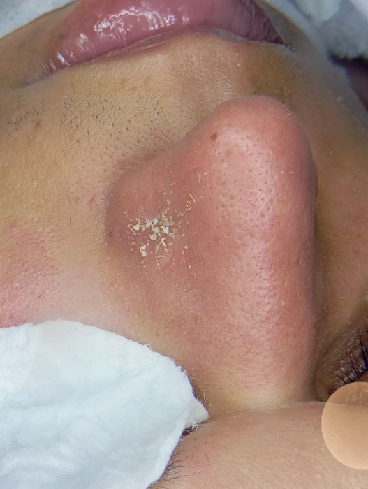 Limpeza de Pele com extração