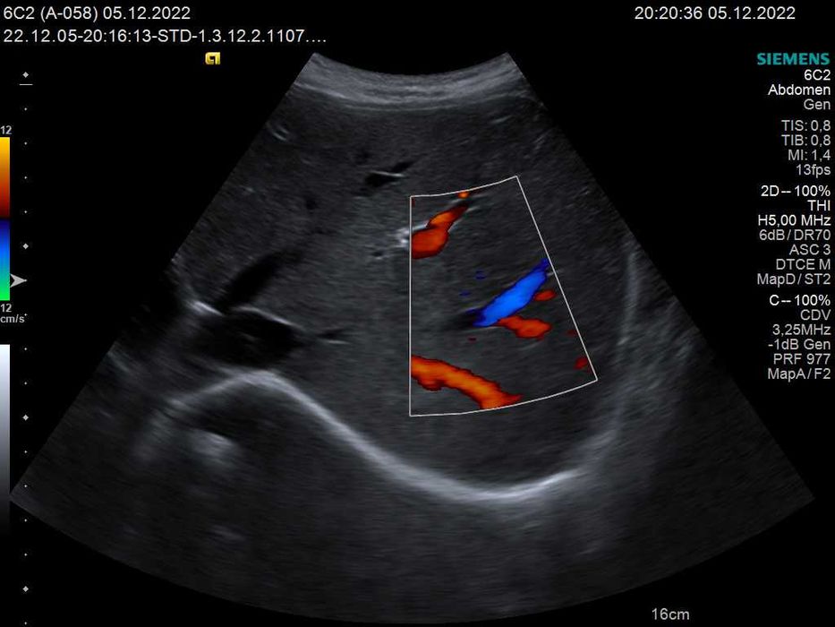 Конвексний датчик УЗД Siemens (Acuson) 6C2