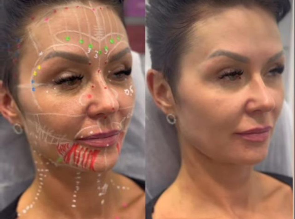 Акция!Индивидуальное обучение:ботулинотерапия,контурная пластика губ