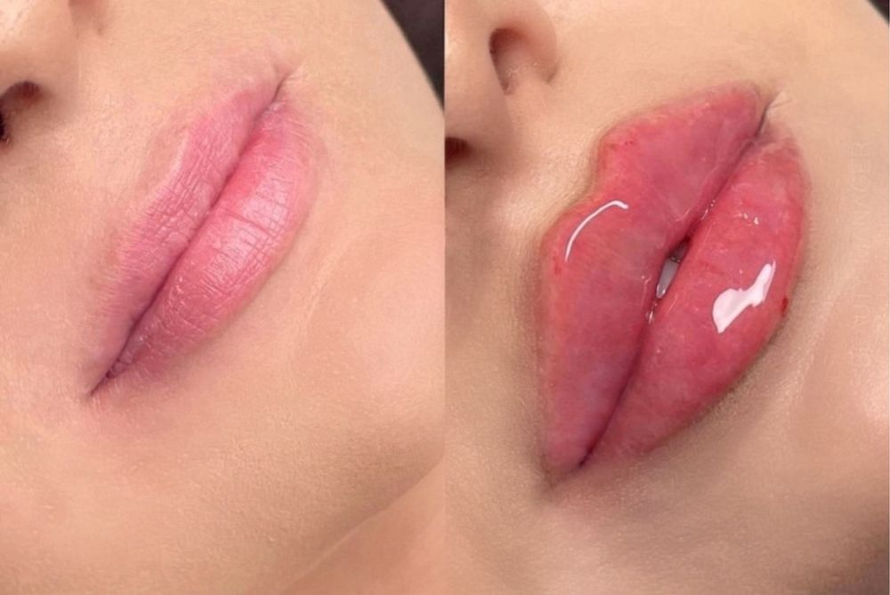 Увеличение губ !