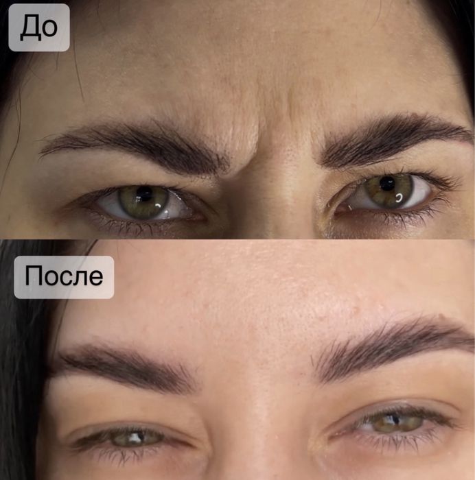 Ботокс| Все зоны | Одесса| Цент