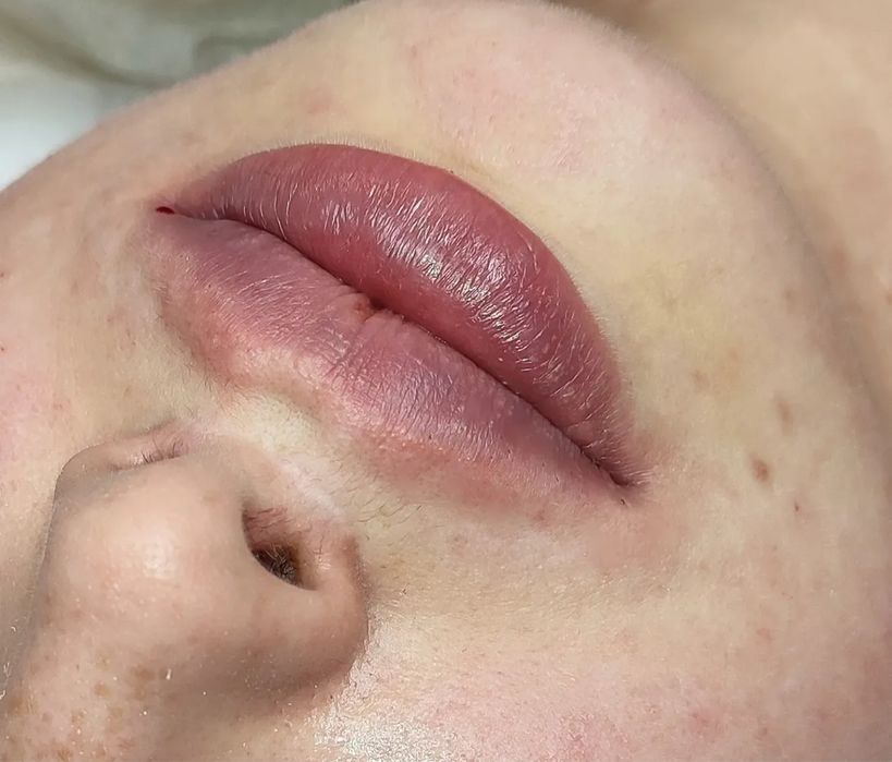 Увеличение губ 1800 грн Контурная пластика | Ботулинотерапия