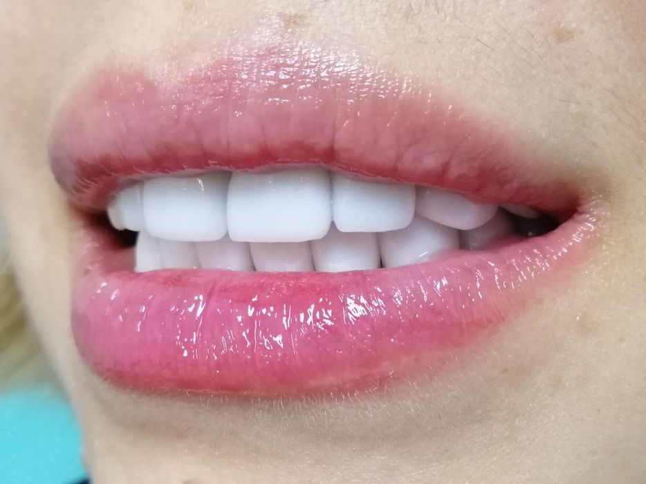 Керамічні вініри. Київ, 13500 грн . Акція! ВСЕ ВКЛЮЧЕНО!!! Е.max