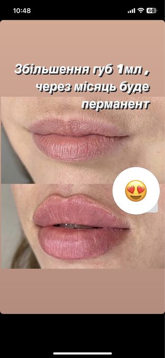 Збільшення губ троєщина 2000-1мл