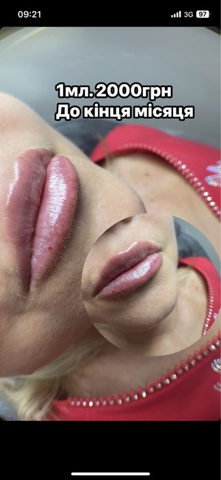 Збільшення губ троєщина 2000