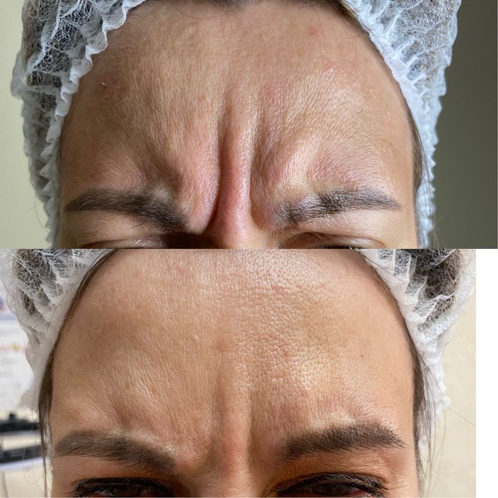 Косметолог (ботокс, контурная пластика губ,мезо, біоревіталізація)