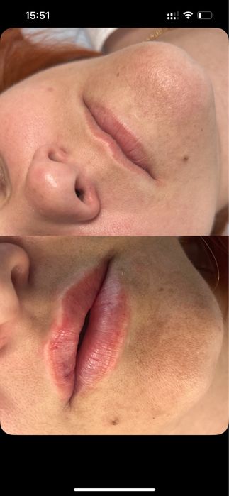 Увеличение губ 1800 грн Контурная пластика | Ботулинотерапия