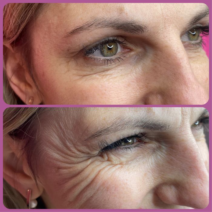 Збільшення губ , ботокс, косметолог