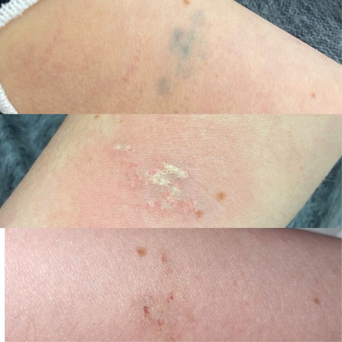 Видалення татуювання, перманенту