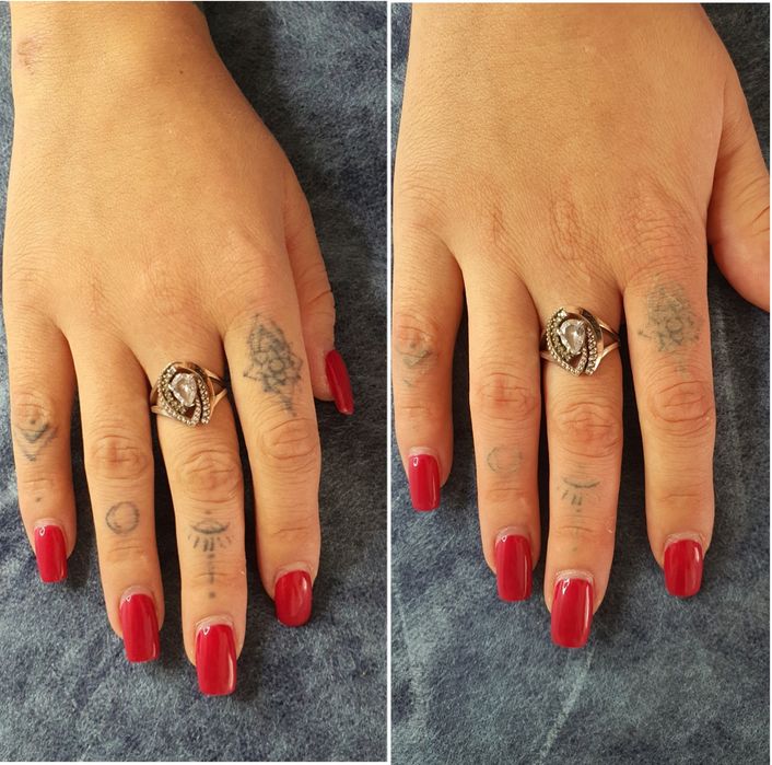 Удаление тату, Удаление татуажа, удаление перманента