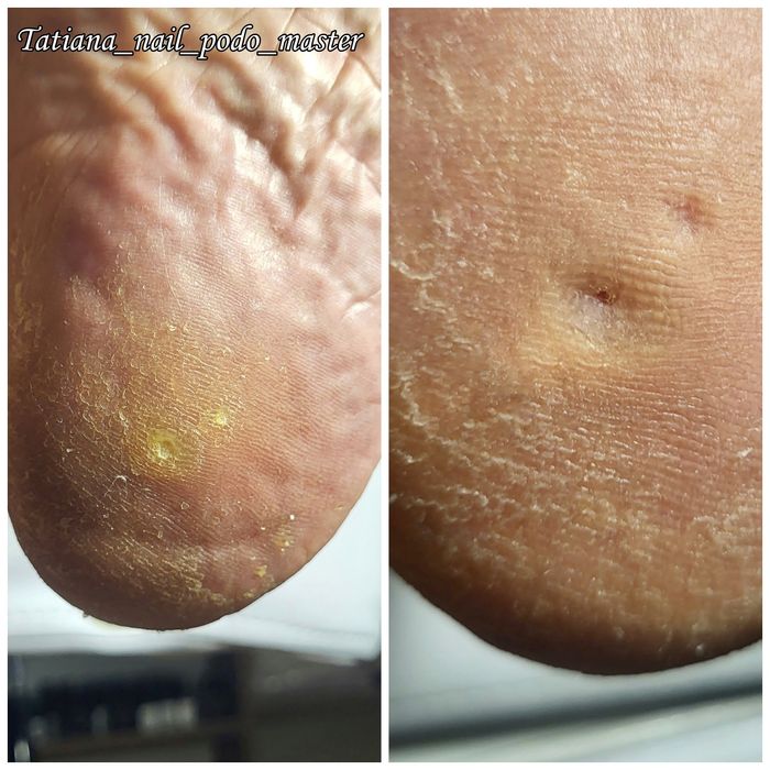 Подолог. Бородавки. Вросший ноготь. Мозоли. Грибок