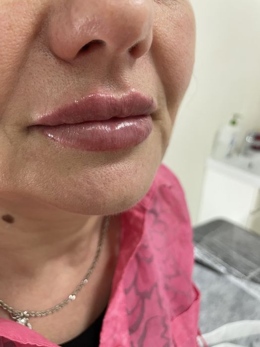 Збільшення губ троєщина 2000-1мл