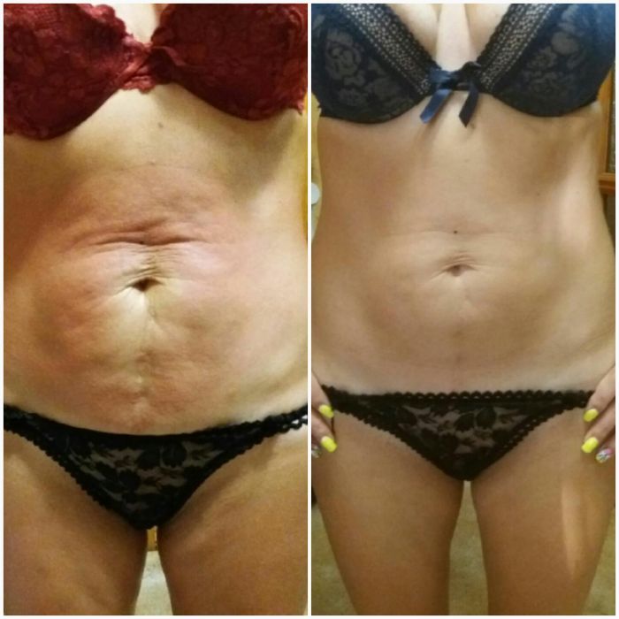 Вакумний антицелюлітний масаж