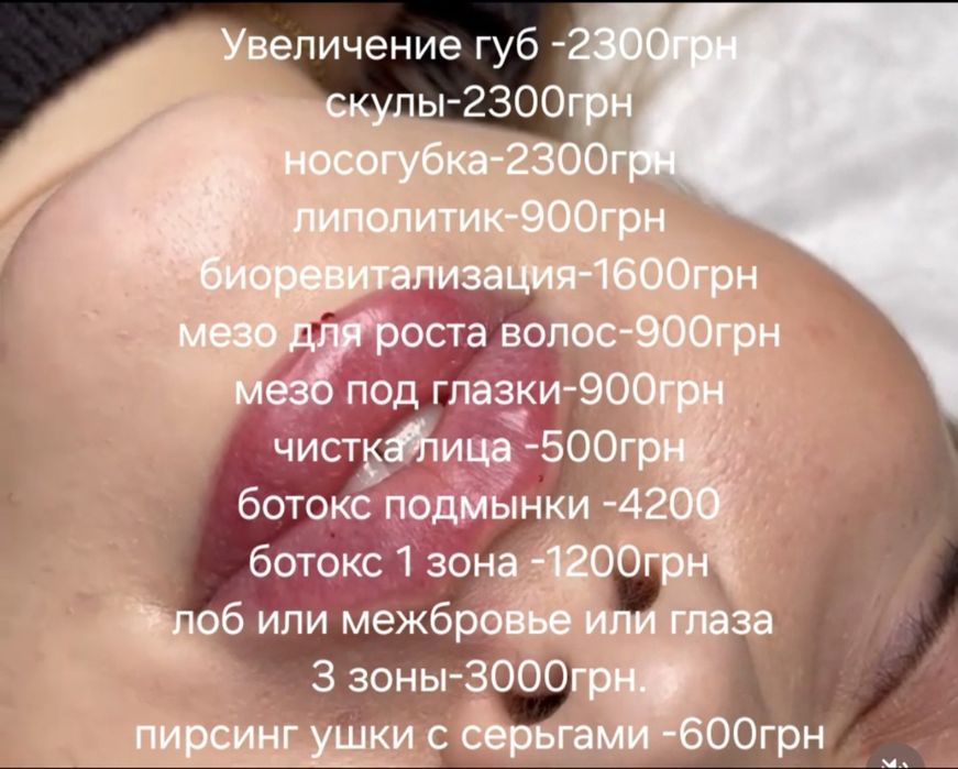 збільшення губ косметолог, біоревіталізація, збільшення скул, мезотера