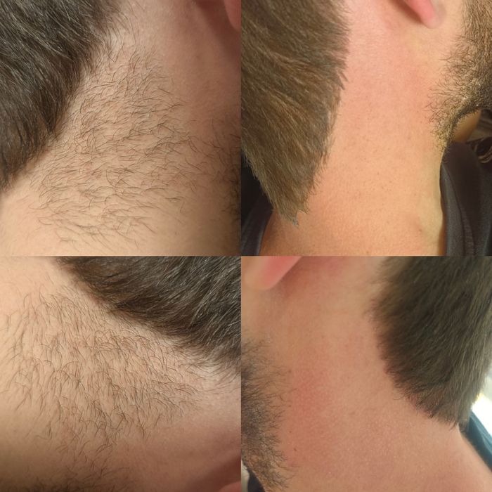 Чоловіча депіляція, видалення волосся для чоловіків на тілі та обличчі
