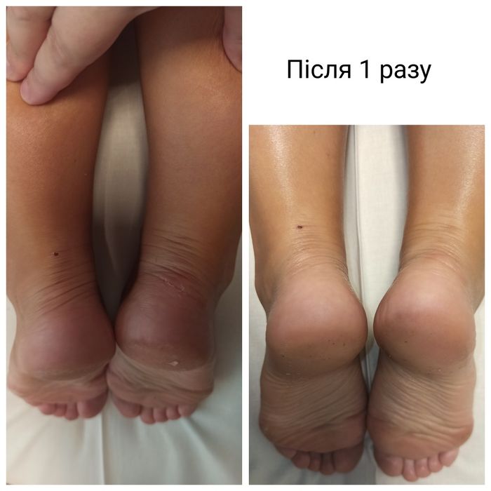 Масаж спини , сколіоз , кифоз , массаж сколиоз