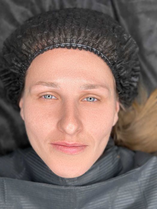 Ботокс Перманентний макіяж/Брови губи повіки Ринопластика без операції