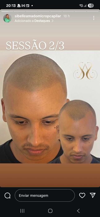 Micropigmentação capilar.