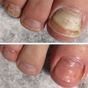 Мужской педикюр и маникюр в Запорожье, педикюр военным, подолог