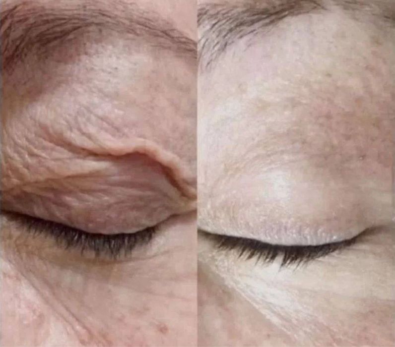 Косметолог моделі на(губи,ботокс,смас,рф голка,схуднення,худе обличчя)