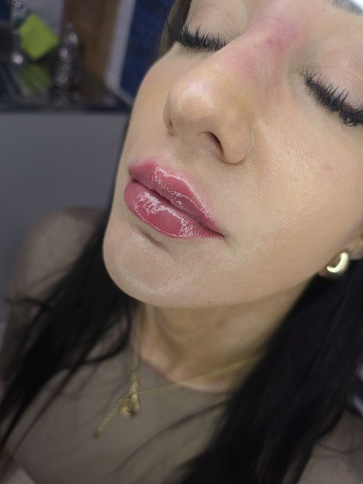 Promocja botox 1 okolica 150zł , usta 370